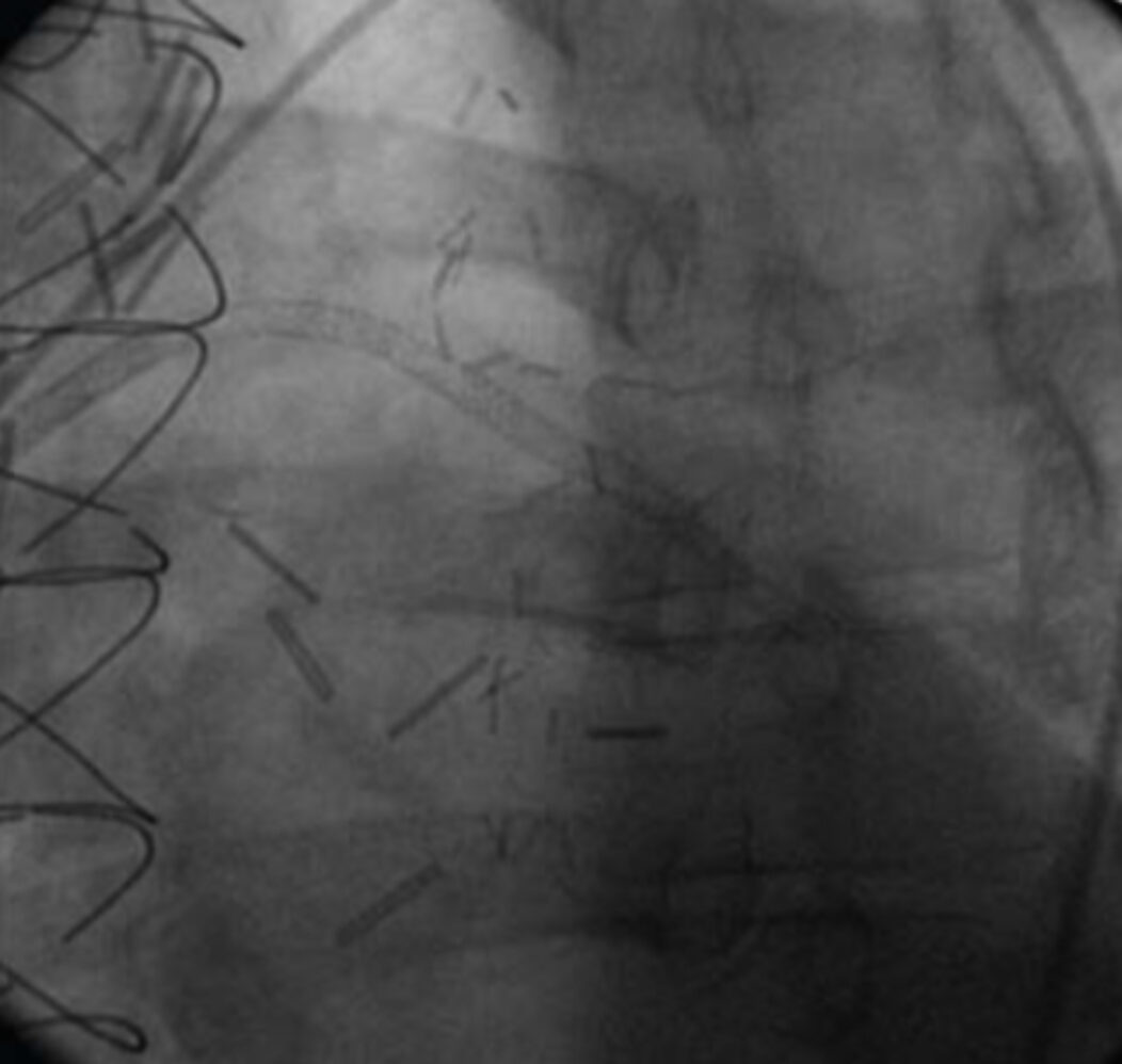 Cordis Case Study Example 1